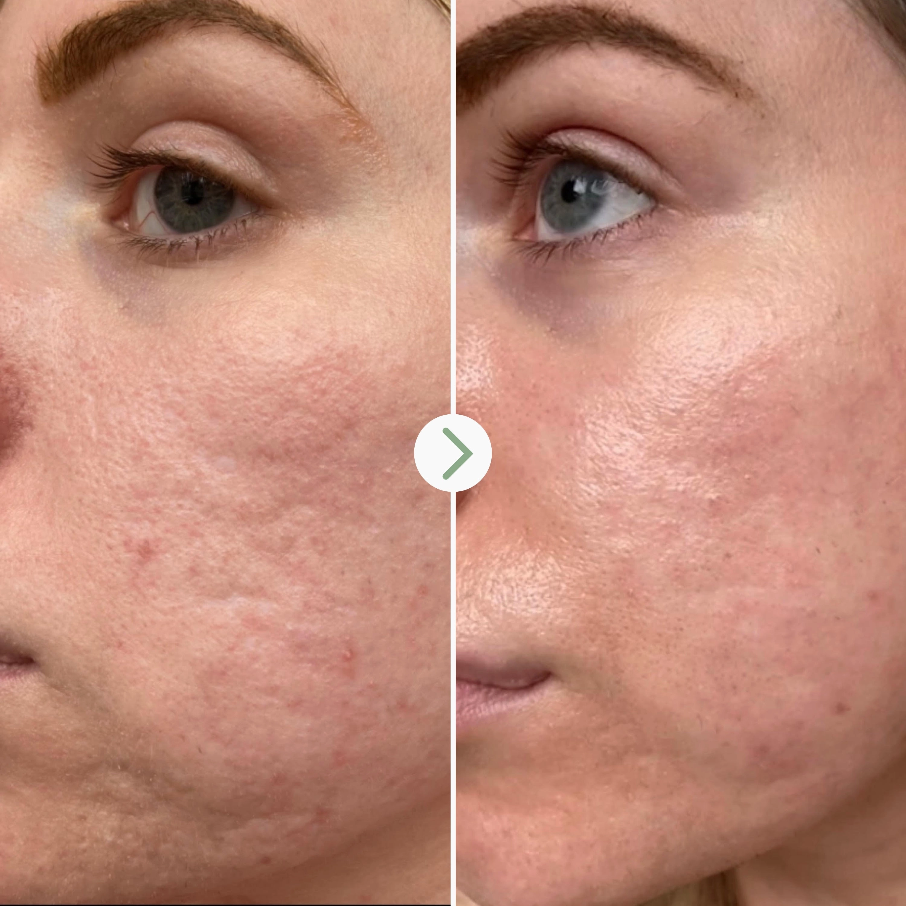 Hyaluronic Acid