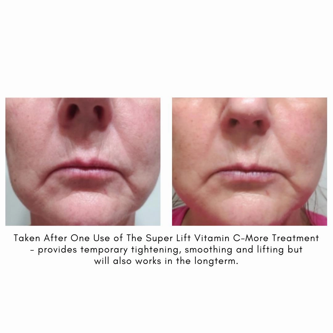 The Super Lift Vitamin C-More Treatment