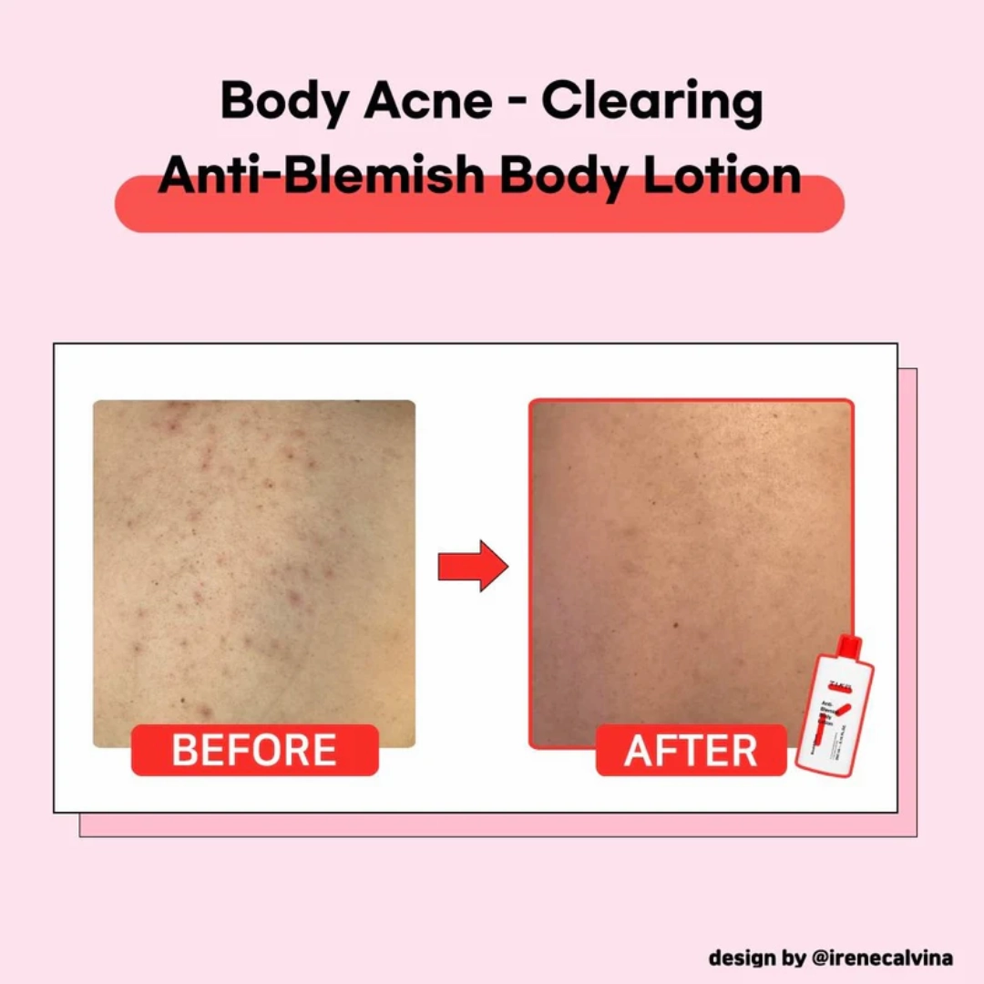 TIAM Anti-Blemish Body Lotion